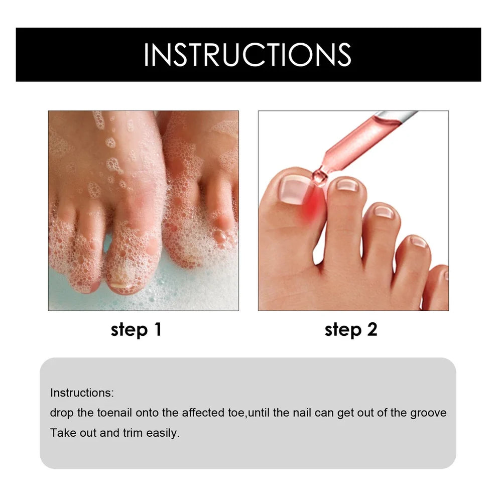 SouthMoon Ingrown Toenail Drops Nail Fungal Repair( BUY 1 GET 1 FREE)