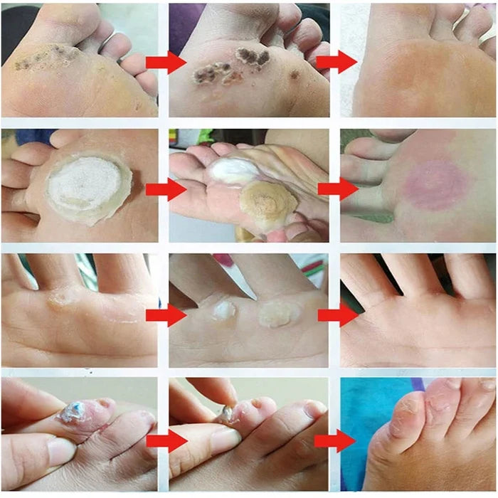 Corn Remover Pads (🔥Buy 1 Get 1 Free🔥)