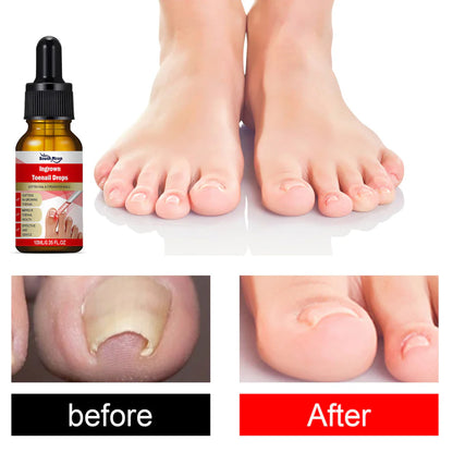 SouthMoon Ingrown Toenail Drops Nail Fungal Repair( BUY 1 GET 1 FREE)